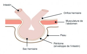 Schema Hernie Hernie Abdominale Bordeaux