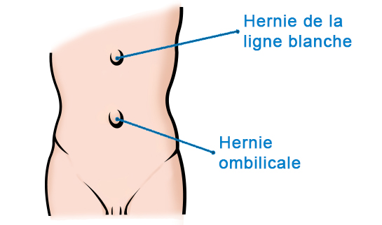 Hernie ombilicale et épigastrique - Hernie Abdominale Bordeaux